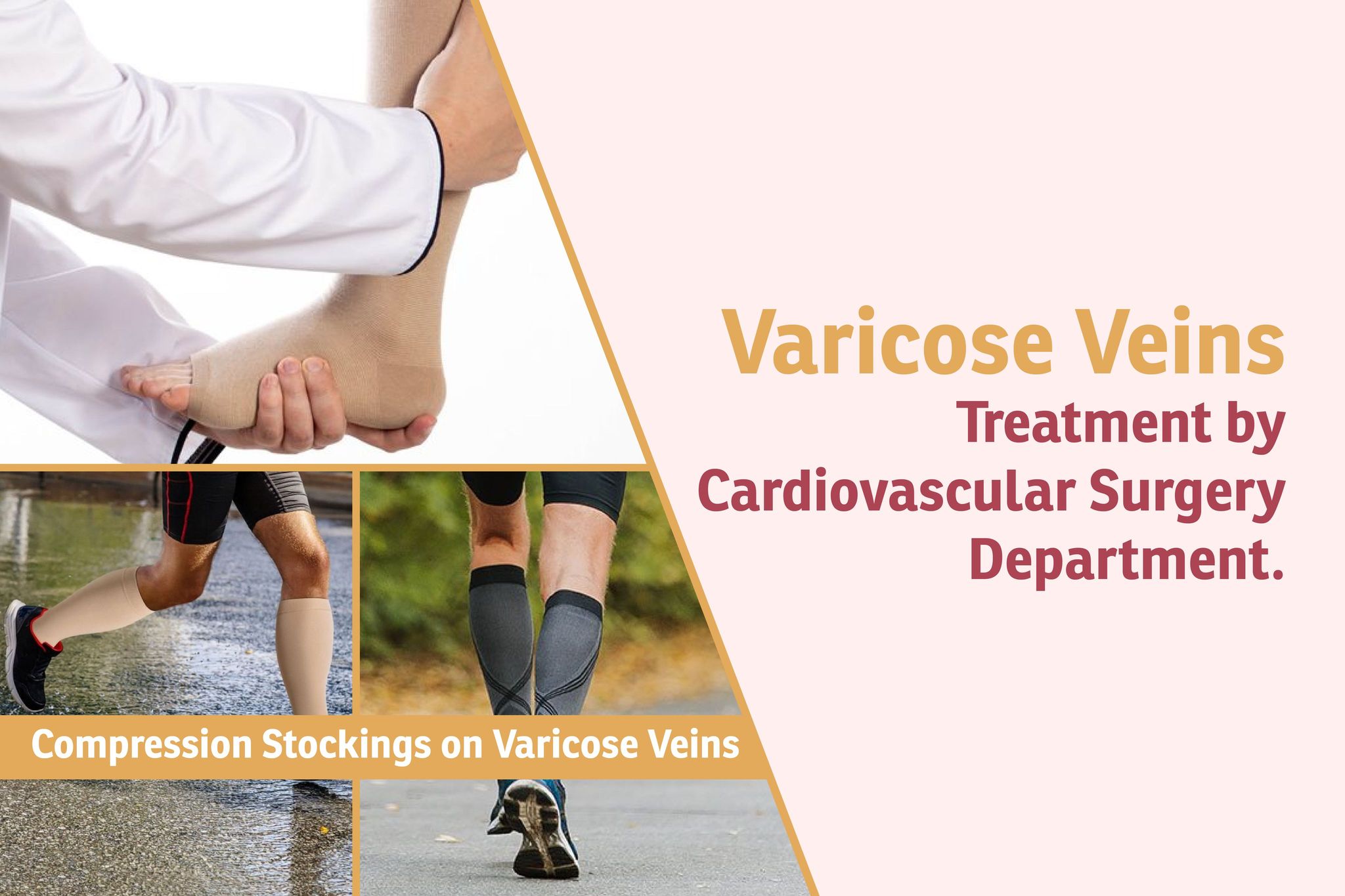 Compression Stockings on Varicose Veins