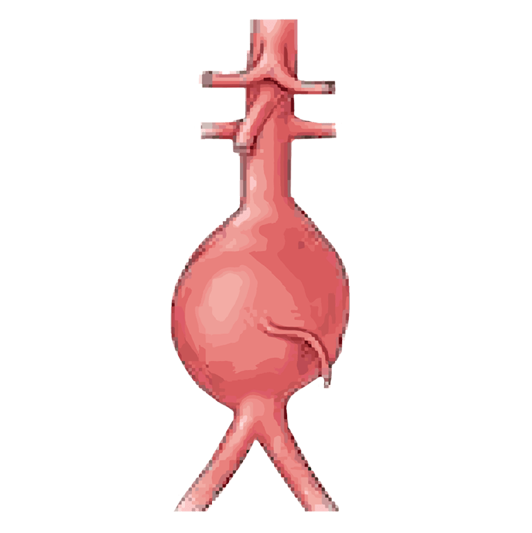 Aortic Aneurysm | Ship Hospital