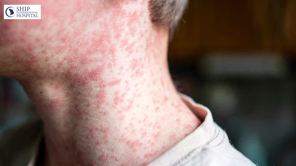 হাম (Measles) - অনেকেই ভাবেন এটা “সাধারণ” রোগ !